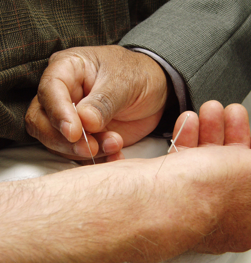 Acupunctura. Foto: Kyle Hunter (licencia CC)