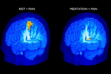 El cerebro dolorido con y sin meditacion