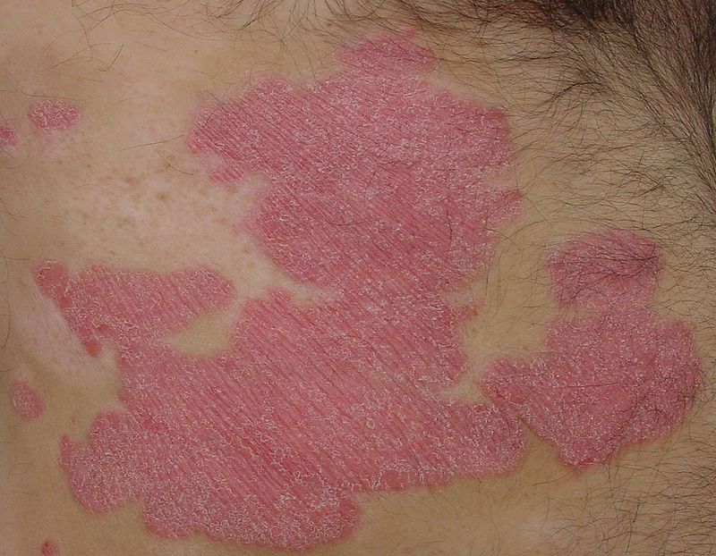 Placa de psoriasis. Foto; Eisfelder (licencia CC)