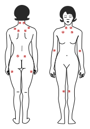 Puntos sensibles en la fibromialgia